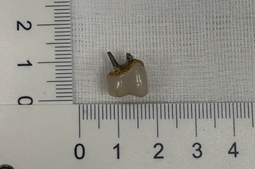 ▲有患者臼齒牙套隨著食物一起吞下肚。（圖／馬偕醫院提供）