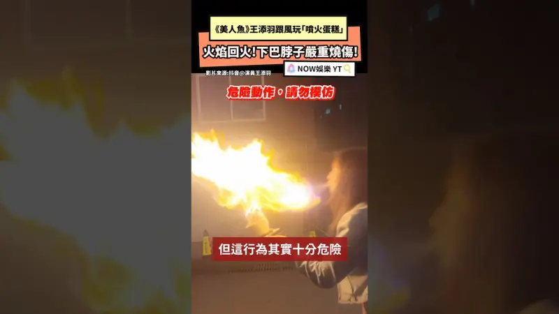 「噴火蛋糕」 火焰回火!下巴脖子嚴重燒傷!